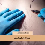 درمان ژنیکوماستی