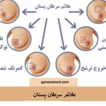 علائم و نشانه‌های سرطان پستان راهنمای کامل