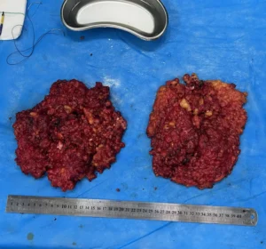 Gynecomastia tissues
