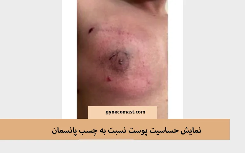 حساسیت پوست به چسب پانسمان ژنیکوماستی