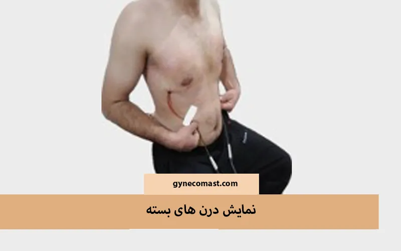 درن بسته