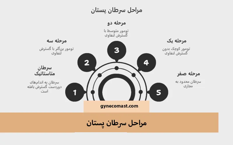 مراحل سرطان پستان