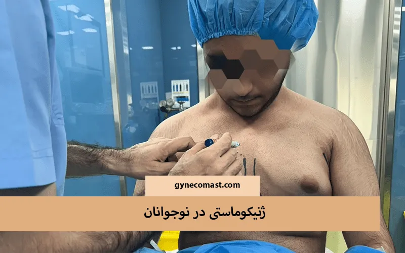 ژنیکوماستی در نوجوانان