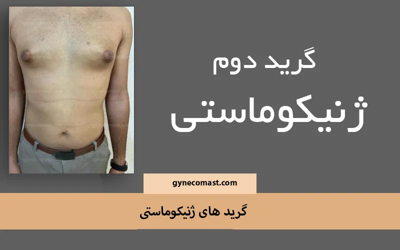 ژنیکوماستی گرید ۲