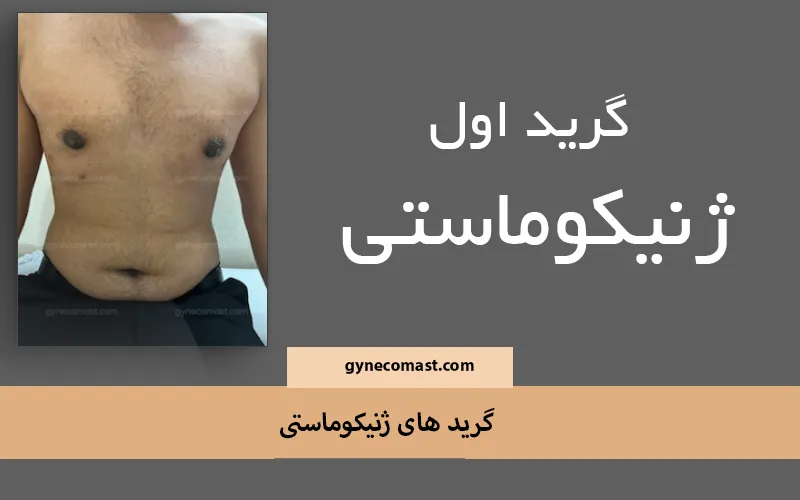 گرید اول ژنیکوماستی