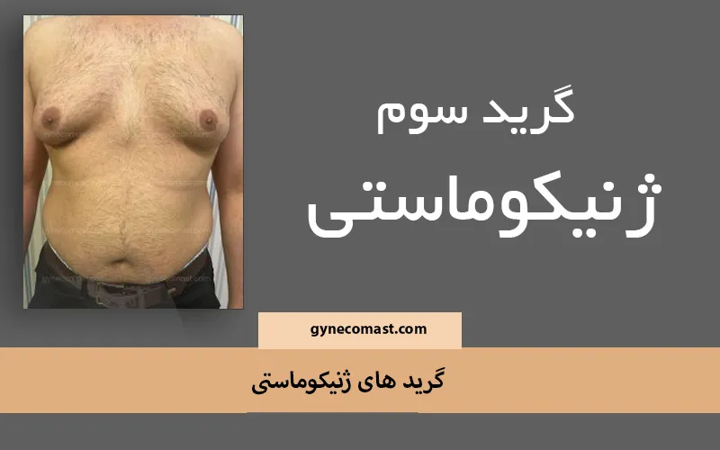 ژنیکوماستی گرید ۳