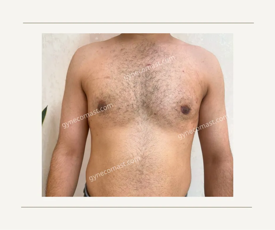 قبل و بعد عمل ژنیکوماستی