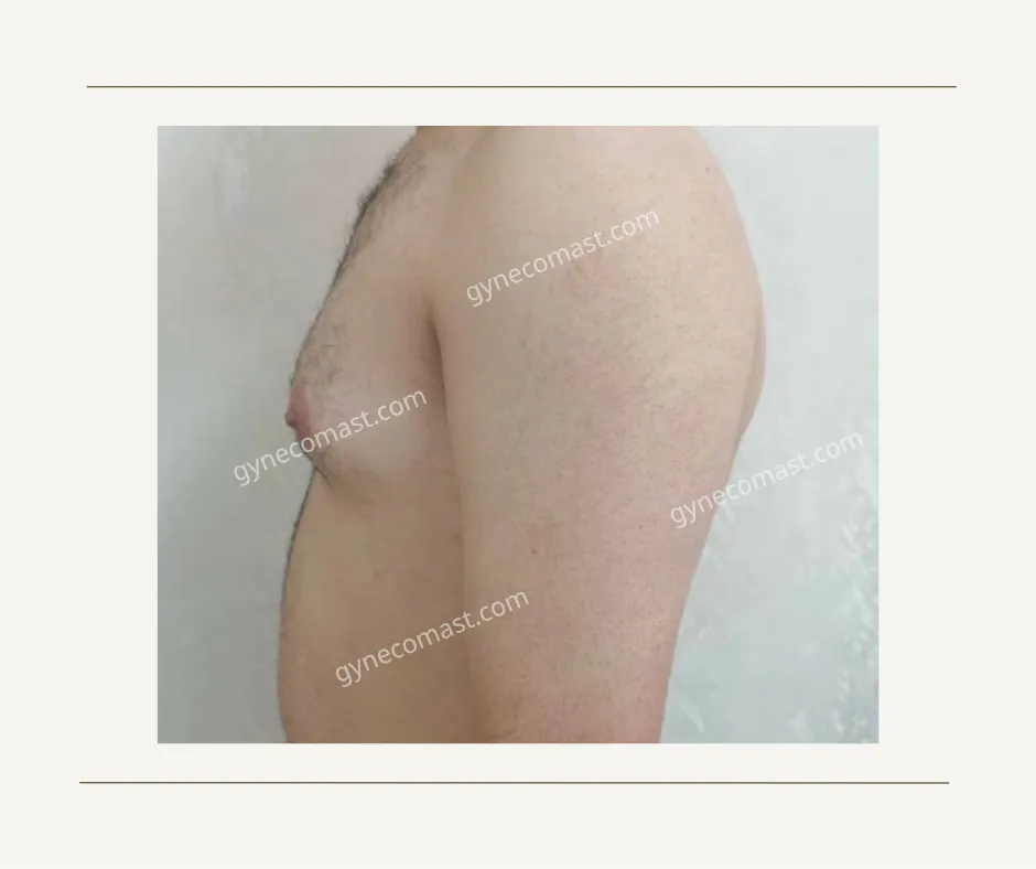 قبل و بعد عمل ژنیکوماستی